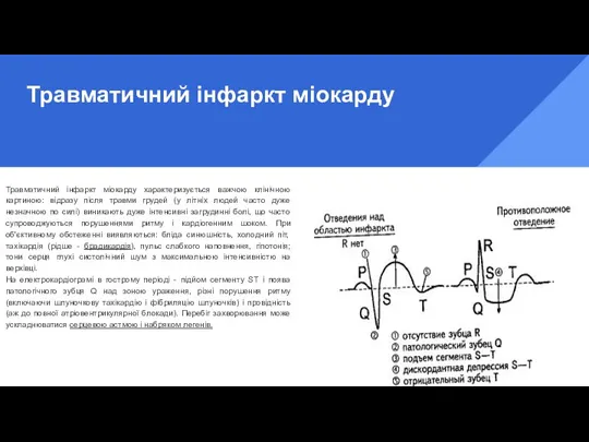 Травматичний інфаркт міокарду Травматичний інфаркт міокарду характеризується важчою клінічною картиною: відразу після