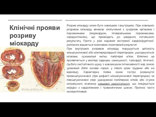 Клінічні прояви розриву міокарду Розрив міокарду може бути зовнішнім і внутрішнім. При