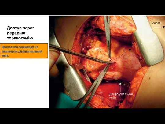 Доступ через передню торакотомію При розитні перикарду, не пошкодити діафрагмальний нерв.