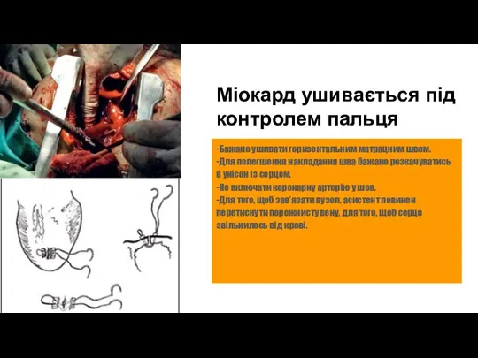 Міокард ушивається під контролем пальця -Бажано ушивати горизонтальним матрацним швом. -Для полегшення