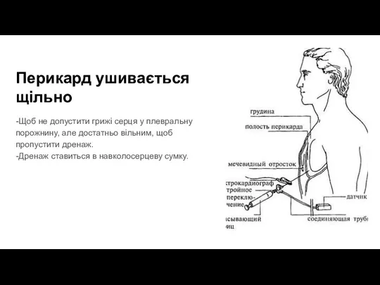 Перикард ушивається щільно -Щоб не допустити грижі серця у плевральну порожнину, але