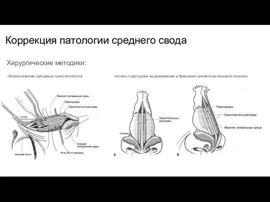 Коррекция патологии среднего свода Хирургические методики: -Использование хрящевых трансплантатов -точное структурное выравнивание