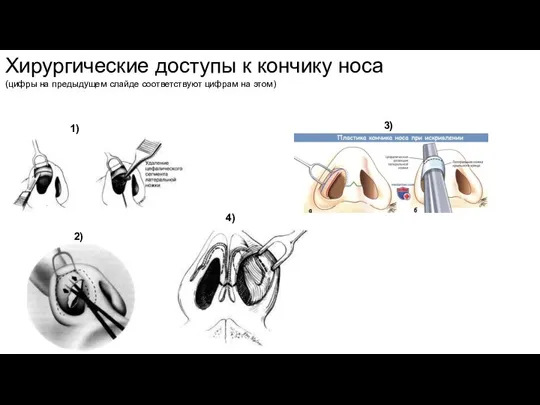 Хирургические доступы к кончику носа (цифры на предыдущем слайде соответствуют цифрам на