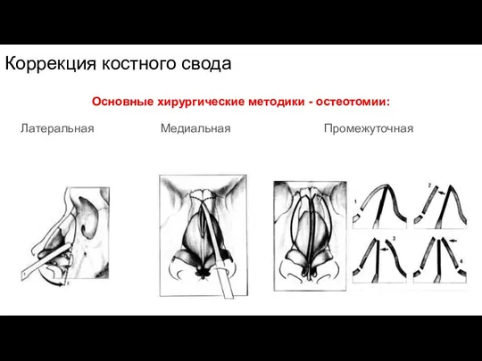 Коррекция костного свода Основные хирургические методики - остеотомии: Латеральная Медиальная Промежуточная