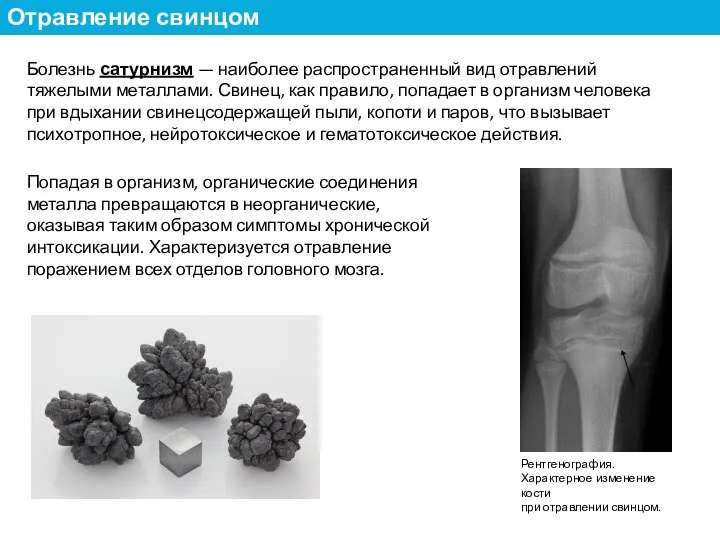 Болезнь сатурнизм — наиболее распространенный вид отравлений тяжелыми металлами. Свинец, как правило,