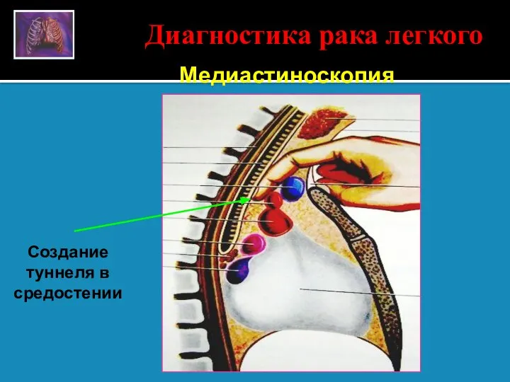 Медиастиноскопия Диагностика рака легкого Создание туннеля в средостении