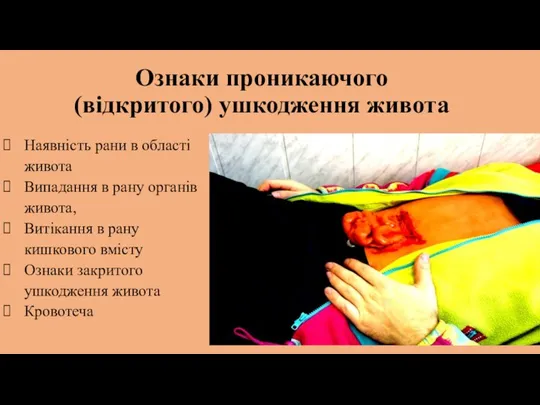 Ознаки проникаючого (відкритого) ушкодження живота Наявність рани в області живота Випадання в