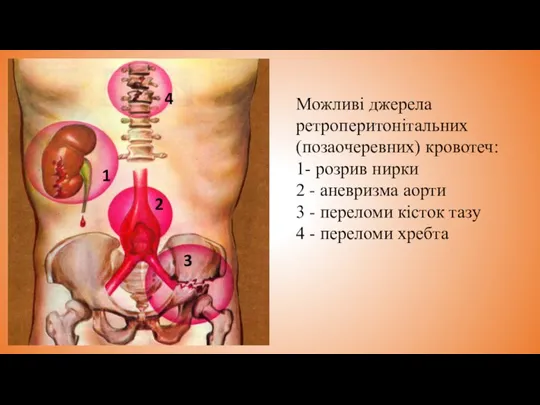 Можливі джерела ретроперитонітальних (позаочеревних) кровотеч: 1- розрив нирки 2 - аневризма аорти