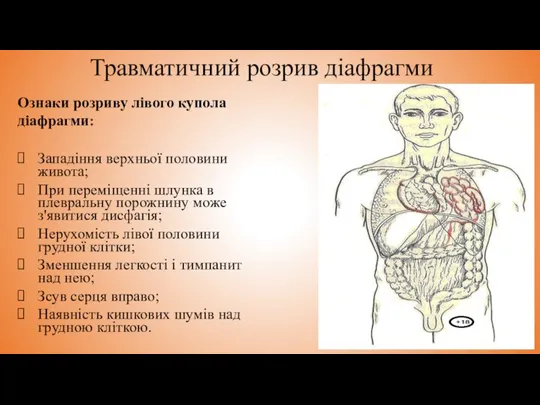 Травматичний розрив діафрагми Ознаки розриву лівого купола діафрагми: Западіння верхньої половини живота;