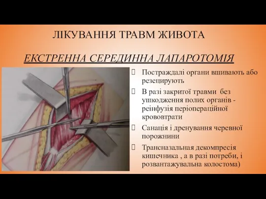 ЛІКУВАННЯ ТРАВМ ЖИВОТА ЕКСТРЕННА СЕРЕДИННА ЛАПАРОТОМІЯ Постраждалі органи вшивають або резецирують В