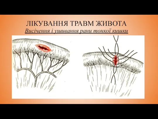 ЛІКУВАННЯ ТРАВМ ЖИВОТА Висічення і ушивання рани тонкої кишки