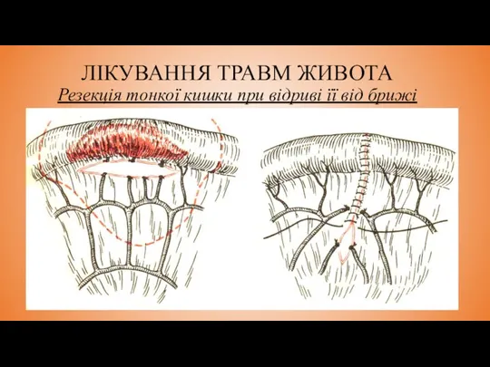 ЛІКУВАННЯ ТРАВМ ЖИВОТА Резекція тонкої кишки при відриві її від брижі