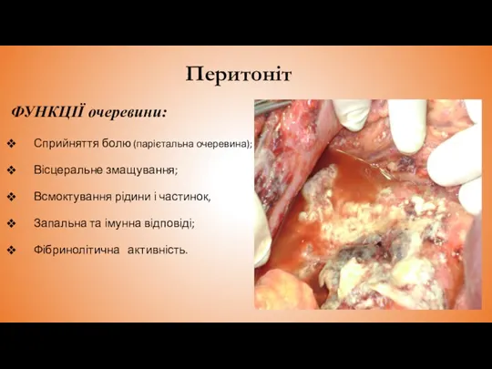 Перитоніт ФУНКЦІЇ очеревини: Сприйняття болю (парієтальна очеревина); Вісцеральне змащування; Всмоктування рідини і