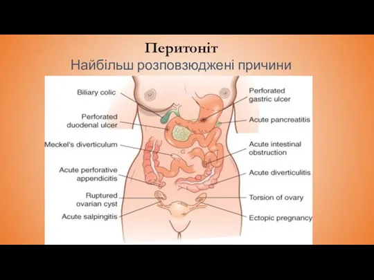 Перитоніт Найбільш розповзюджені причини