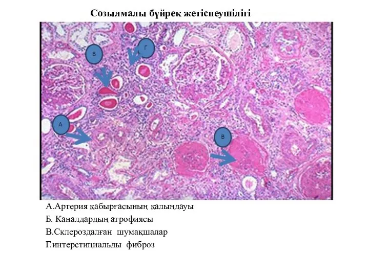 Созылмалы бүйрек жетіспеушілігі А.Артерия қабырғасының қалыңдауы Б. Каналдардың атрофиясы В.Склероздалған шумақшалар Г.интерстициальды фиброз