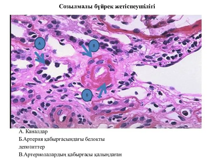 Созылмалы бүйрек жетіспеушілігі А. Каналдар Б.Артерия қабырғасындағы белокты депозиттер В.Артериолалардың қабырғасы қалыңдаған