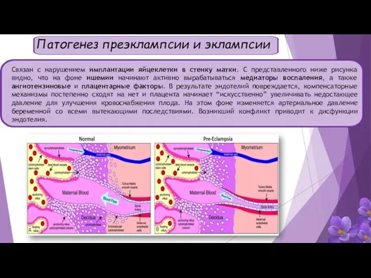 Патогенез преэклампсии и эклампсии Cвязан с нарушением имплантации яйцеклетки в стенку матки.