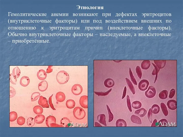Этиология Гемолитические анемии возникают при дефектах эритроцитов (внутриклеточные факторы) или под воздействием