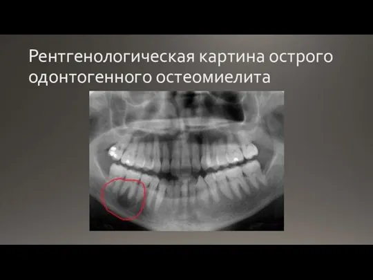 Рентгенологическая картина острого одонтогенного остеомиелита