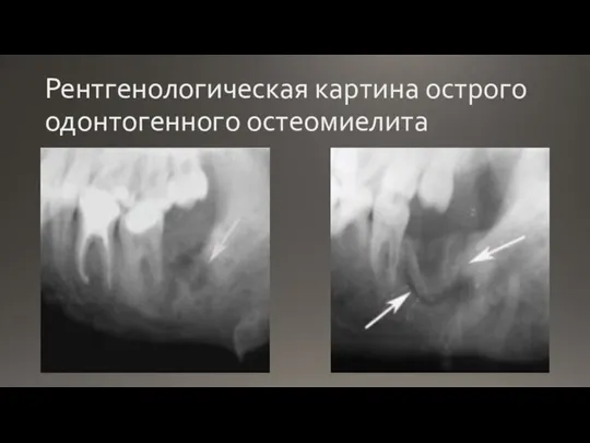 Рентгенологическая картина острого одонтогенного остеомиелита