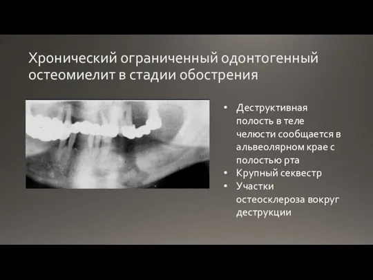 Хронический ограниченный одонтогенный остеомиелит в стадии обострения Деструктивная полость в теле челюсти