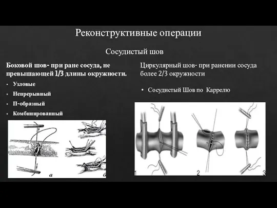 Реконструктивные операции Боковой шов- при ране сосуда, не превышающей 1/3 длины окружности.