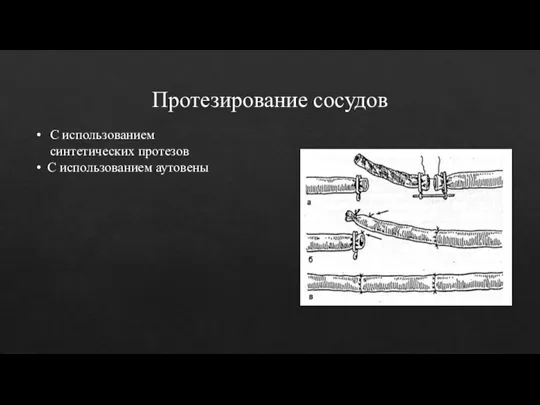 Протезирование сосудов С использованием синтетических протезов С использованием аутовены