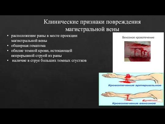 Клинические признаки повреждения магистральной вены расположение раны в месте проекции магистральной вены