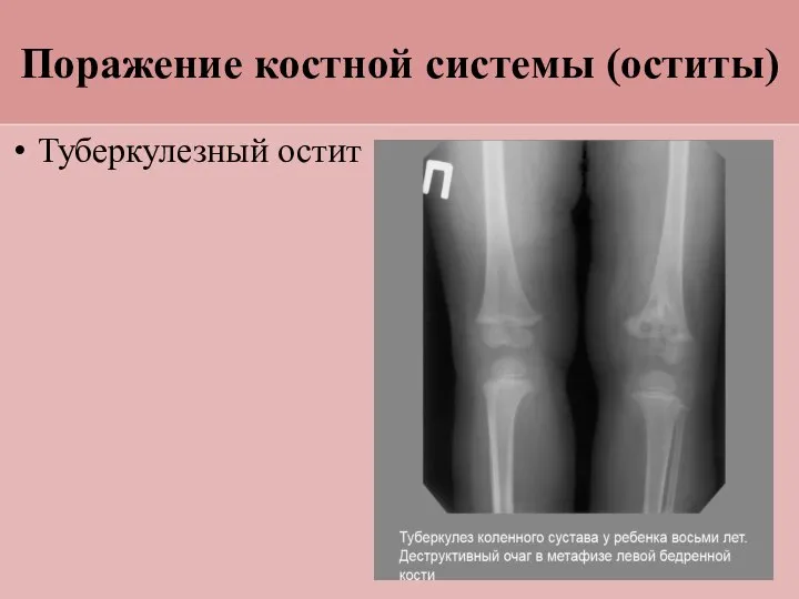 Поражение костной системы (оститы) Туберкулезный остит