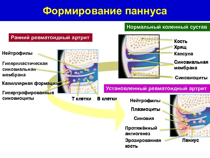 Капиллярная формация Гипертрофированные синовиоциты Нейтрофилы T клетки B клетки Ранний ревматоидный артрит