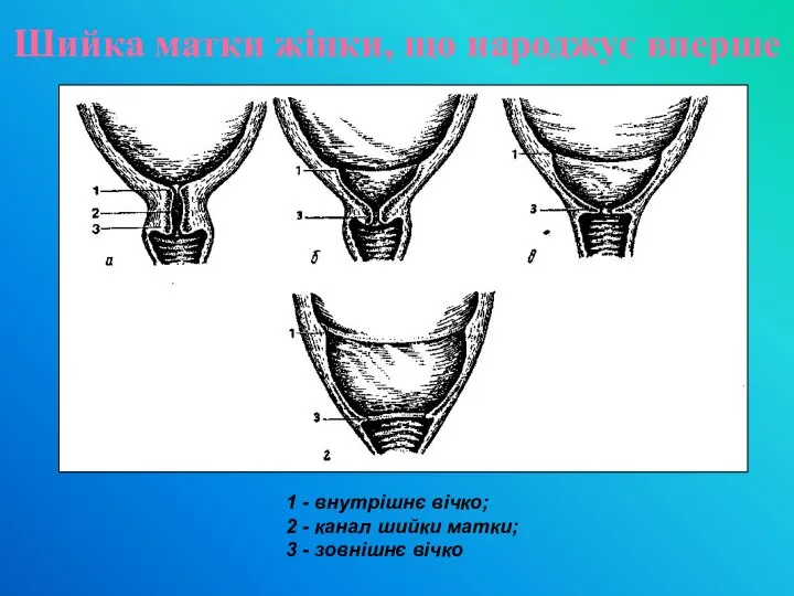 Шийка матки жінки, що народжує вперше 1 - внутрішнє вічко; 2 -
