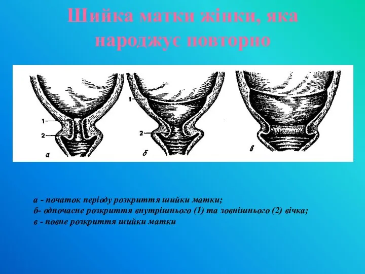 Шийка матки жінки, яка народжує повторно а - початок періоду розкриття шийки