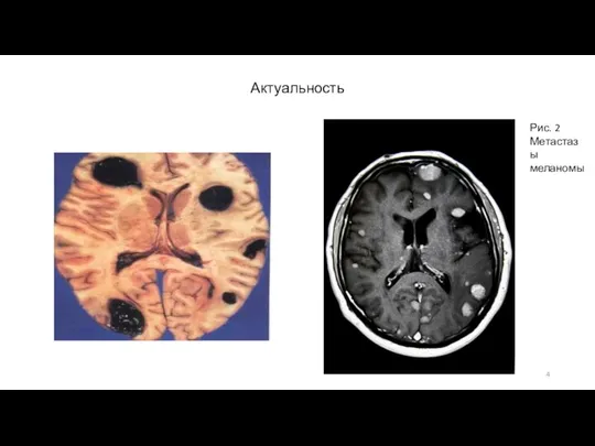 Актуальность Рис. 2 Метастазы меланомы