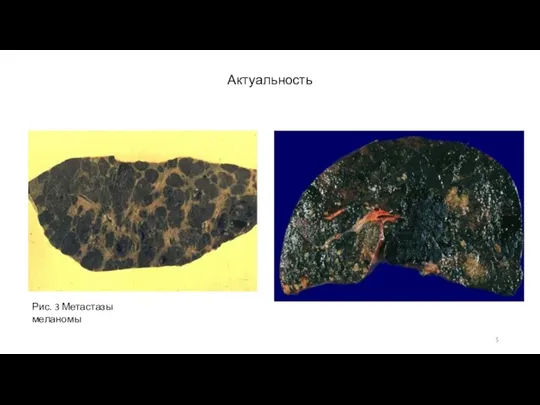 Актуальность Рис. 3 Метастазы меланомы