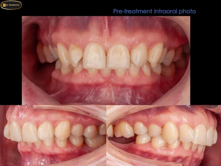 Pre-treatment intraoral photo