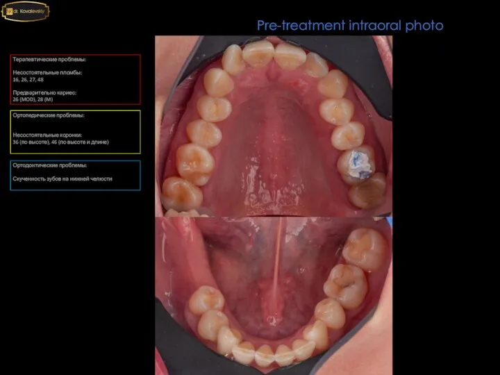 Pre-treatment intraoral photo Терапевтические проблемы: Несостоятельные пломбы: 16, 26, 27, 48 Предварительно