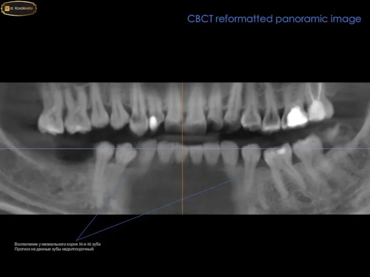 CBCT reformatted panoramic image Воспаление у мезиального корня 36 и 46 зуба