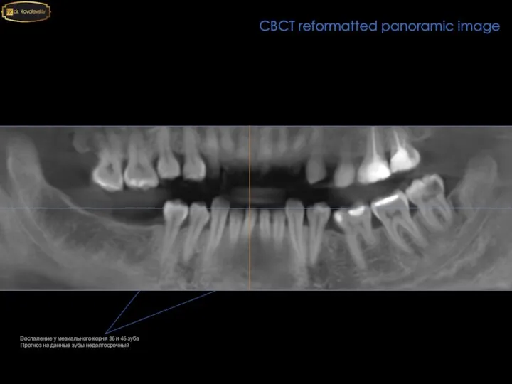 CBCT reformatted panoramic image Воспаление у мезиального корня 36 и 46 зуба