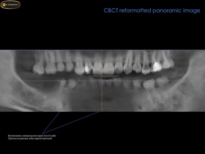 CBCT reformatted panoramic image Воспаление у мезиального корня 36 и 46 зуба
