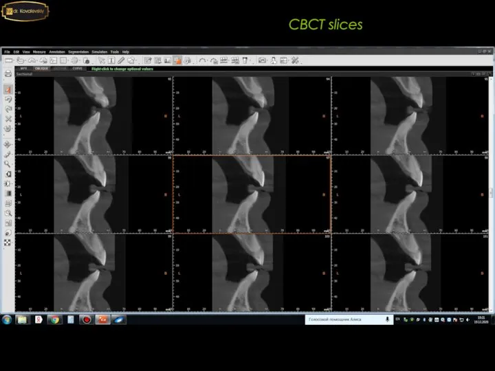 2020 CBCT slices Расположение верхних резцов в кости: Ретрузионное