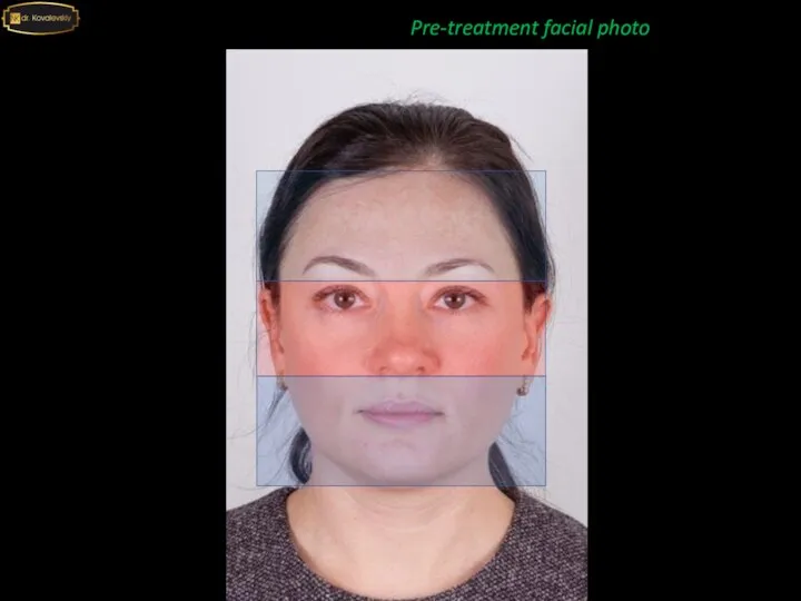 Pre-treatment facial photo