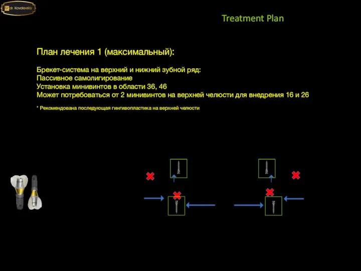 Treatment Plan План лечения 1 (максимальный): Брекет-система на верхний и нижний зубной