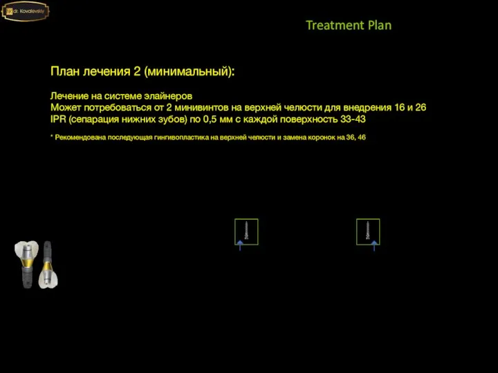 Treatment Plan План лечения 2 (минимальный): Лечение на системе элайнеров Может потребоваться