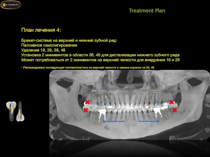 Treatment Plan План лечения 4: Брекет-система на верхний и нижний зубной ряд: