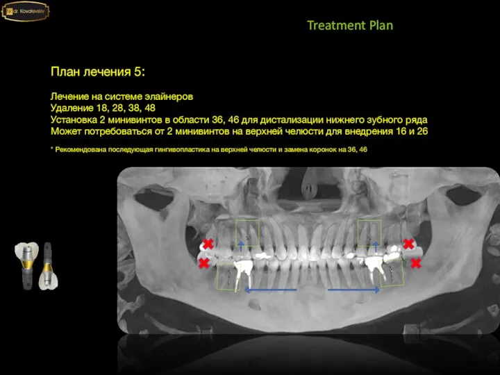 Treatment Plan План лечения 5: Лечение на системе элайнеров Удаление 18, 28,