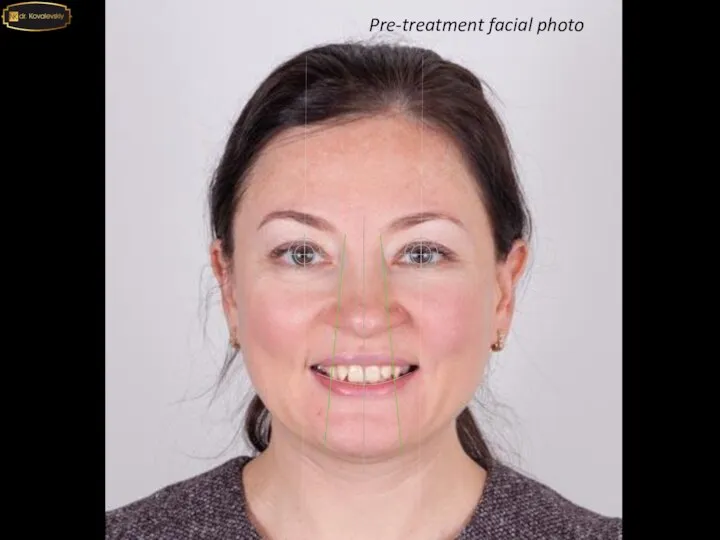 Pre-treatment facial photo