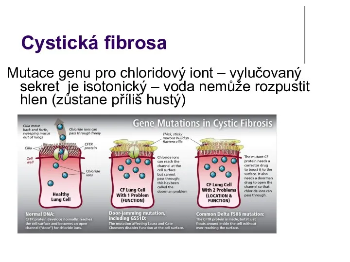 Cystická fibrosa Mutace genu pro chloridový iont – vylučovaný sekret je isotonický