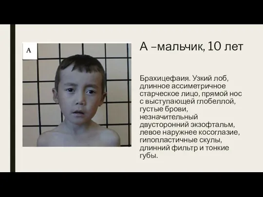 А –мальчик, 10 лет Брахицефаия. Узкий лоб, длинное ассиметричное старческое лицо, прямой