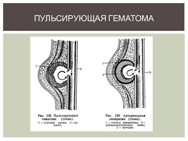 ПУЛЬСИРУЮЩАЯ ГЕМАТОМА