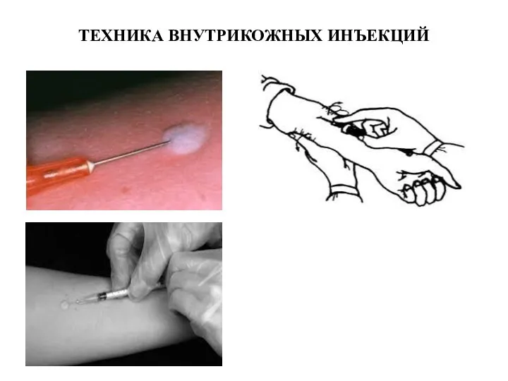 ТЕХНИКА ВНУТРИКОЖНЫХ ИНЪЕКЦИЙ